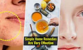 How to cure acne simple trick do it yourself at home